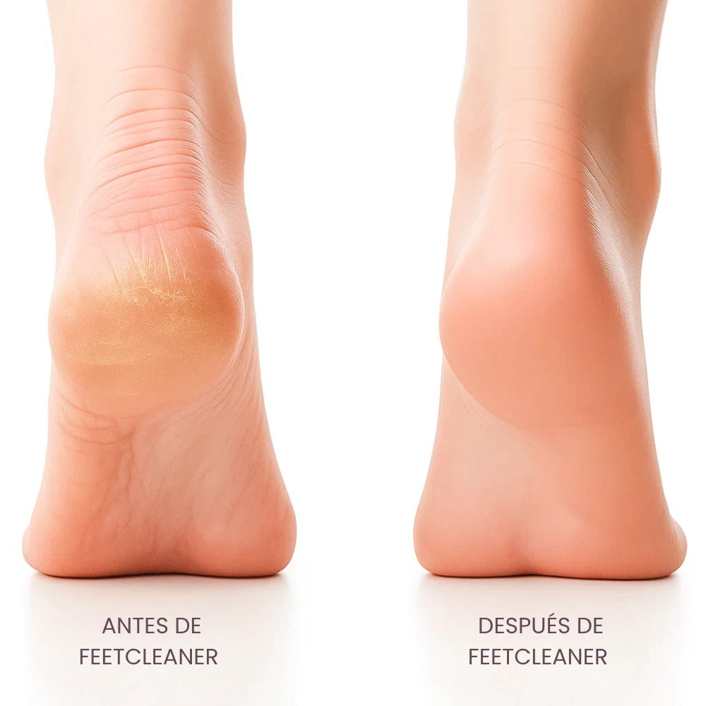 Lima Exfoliador Remueve Callos Pies